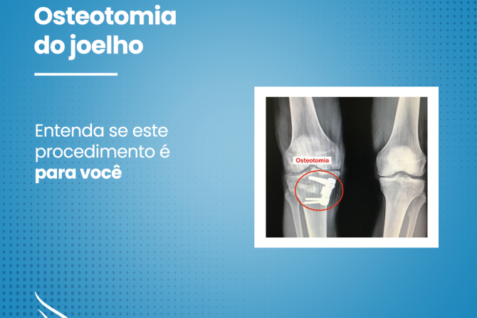 O que você precisa saber sobre osteostomia do joelho